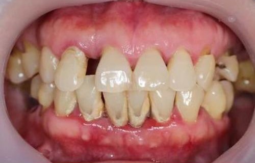 what does gum disease look like in the mouth