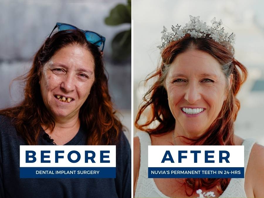 cassie before and after having experienced the drawbacks of dental implants