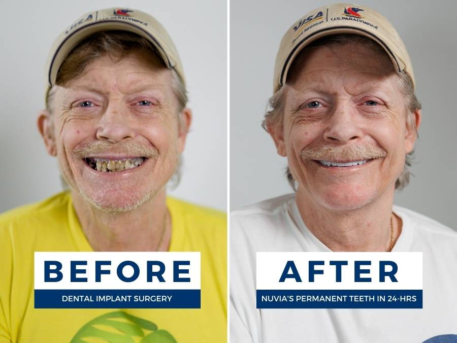 Man smiling before and after dental implants