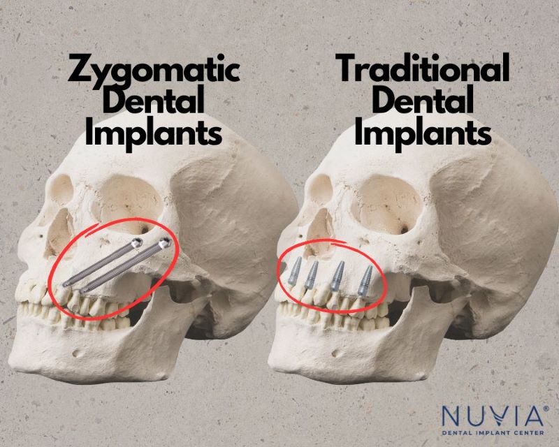 Two skulls showing the difference between zygomatic dental implant and traditional dental implants