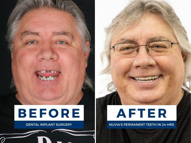 Man receiving one of the types of dental implants before and after photo