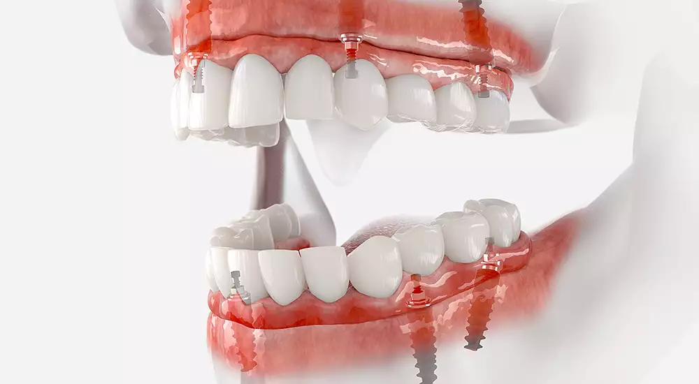 Graphic showing the traditional types of dental implants