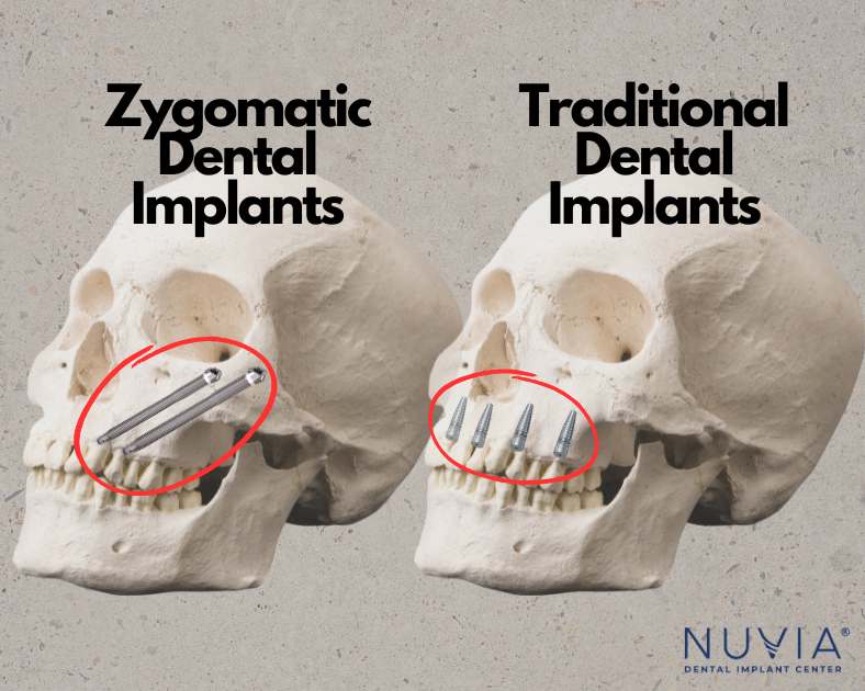 depiction of two types of dental implants, zygomatic and traditional