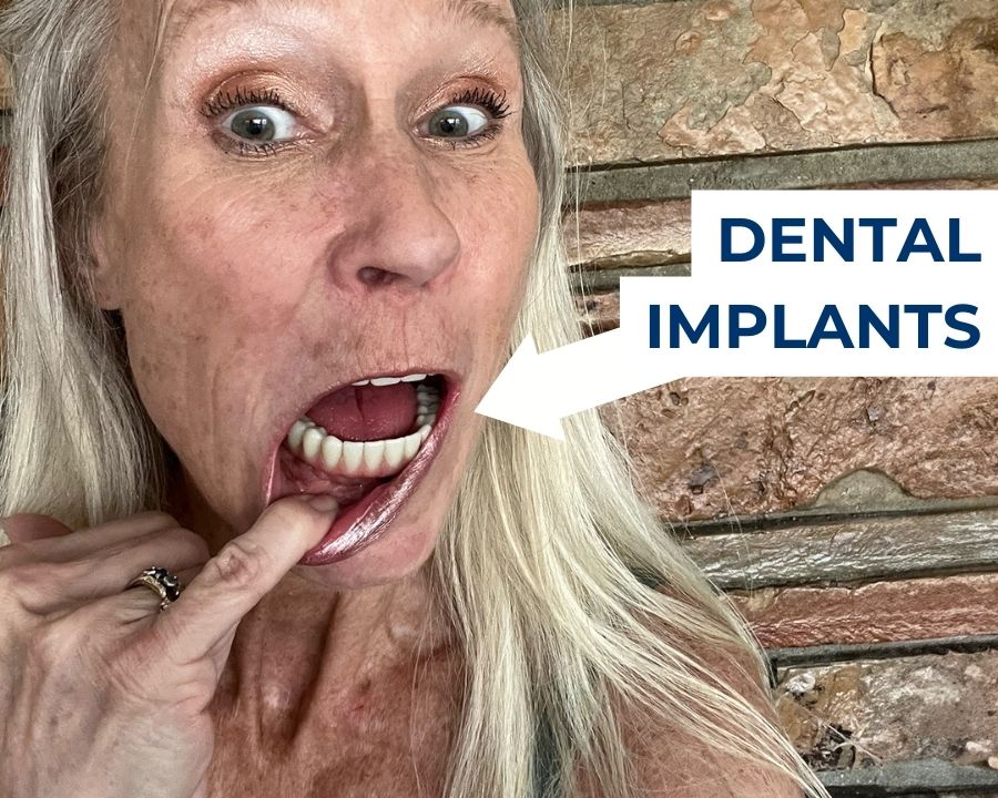 Thumbnail for what is oral surgery with woman showing her dental implants by pulling down her bottom lip