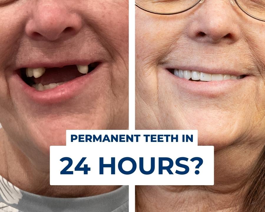 How to fix my teeth showing new teeth in 24 hours