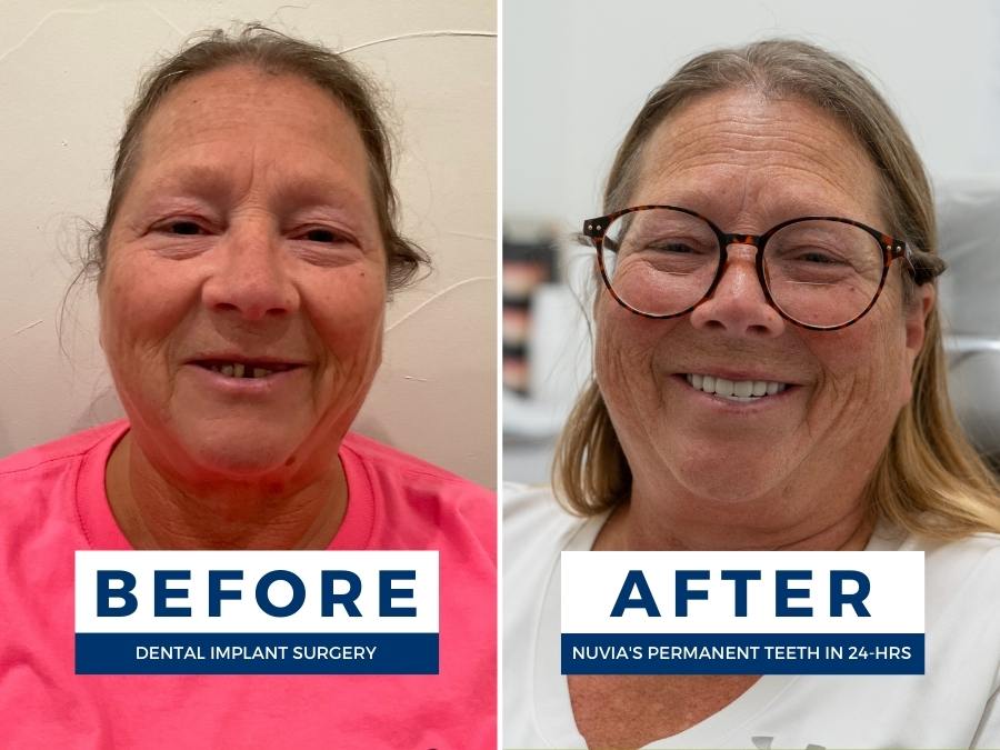 Woman smiling before and after she learned how to fix my teeth and got dental implants