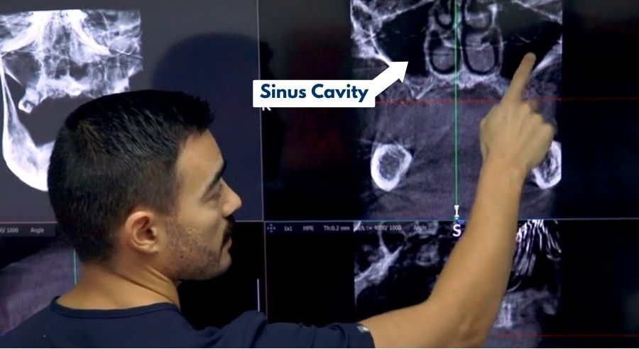 Dr. showing the sinus cavities for patient prepping for sinus lift