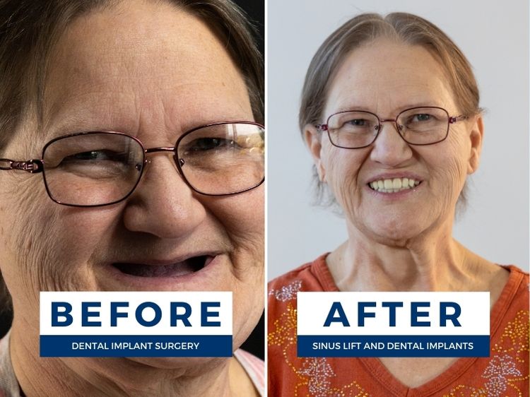 Before and after sinus lift and dental implants