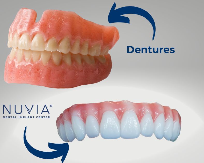 Acrylic dentures vs Nuvia dental implants