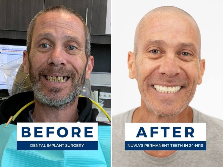 when is it too late to get dental implants answered in part by this before and after of a man smiling with new teeth