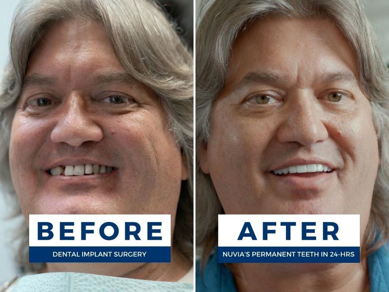 Michael before and after dealing with upper dentures problems