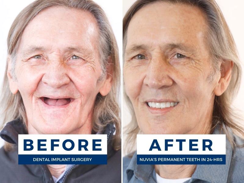 Michael smiling before and after dental implants to fix upper denture problems