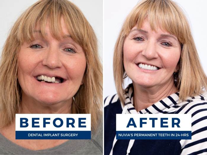 Terri Smiling before and after smile makeover