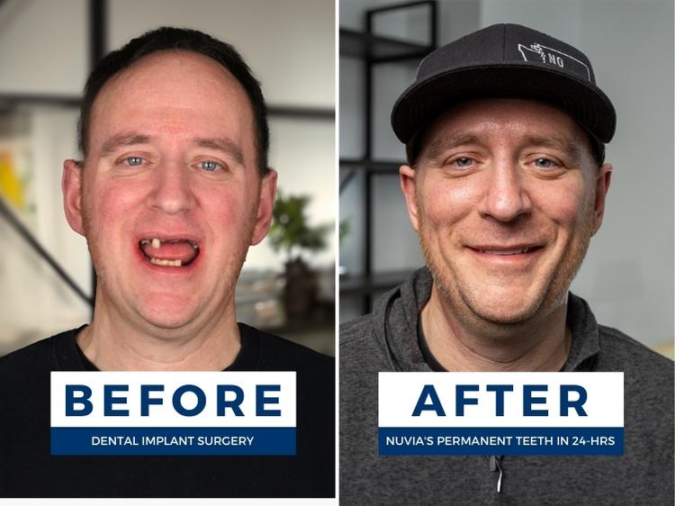 man with tooth loss smiling before and after dental implants