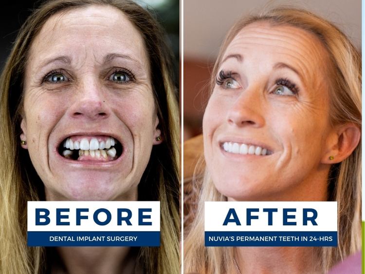 Michelle before and after dental implants