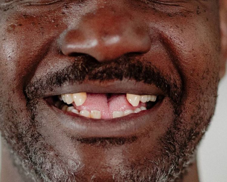 Picture of the result of what causes teeth to fall out
