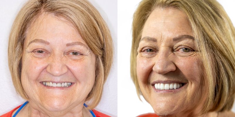 Laura before and after dental implants problems