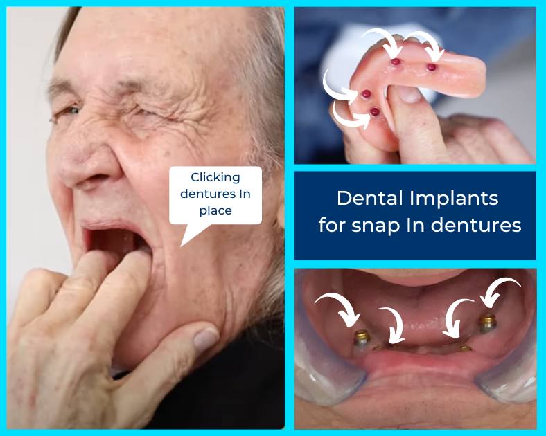 Patient dealing with problems with snap-in dentures and diagram showing how they work.