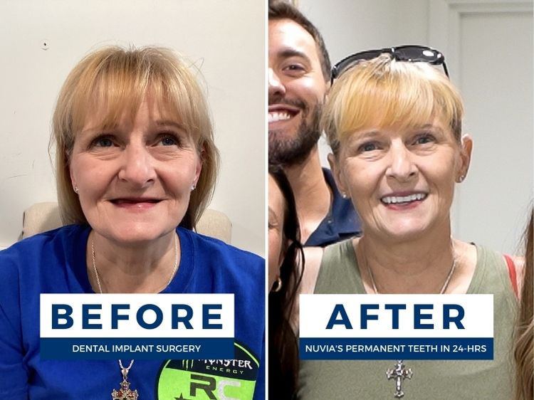 Patient smiling before and after no longer dealing with the problems with snap-in dentures
