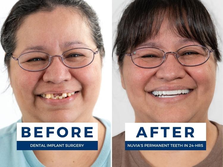 Patient who said i have really bad teeth, what are my options before and after dental implants
