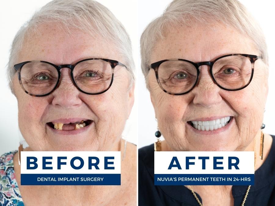 Before and after dental implants for woman who said my teeth are falling out