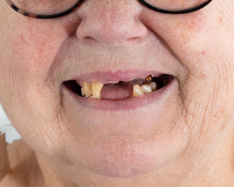 My teeth are falling out before dental implants