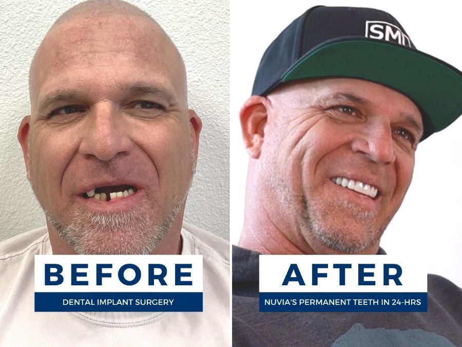 Dennis before and after dental implants smiling