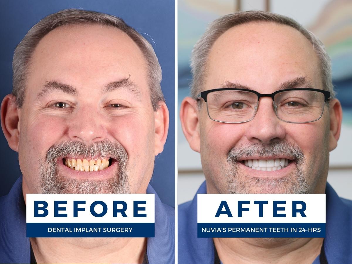 Before and after dental implants for patient with bad teeth