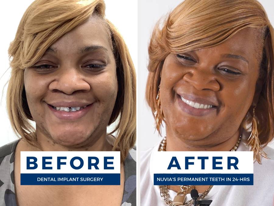 Before and after of Sharanna after dental implant financing