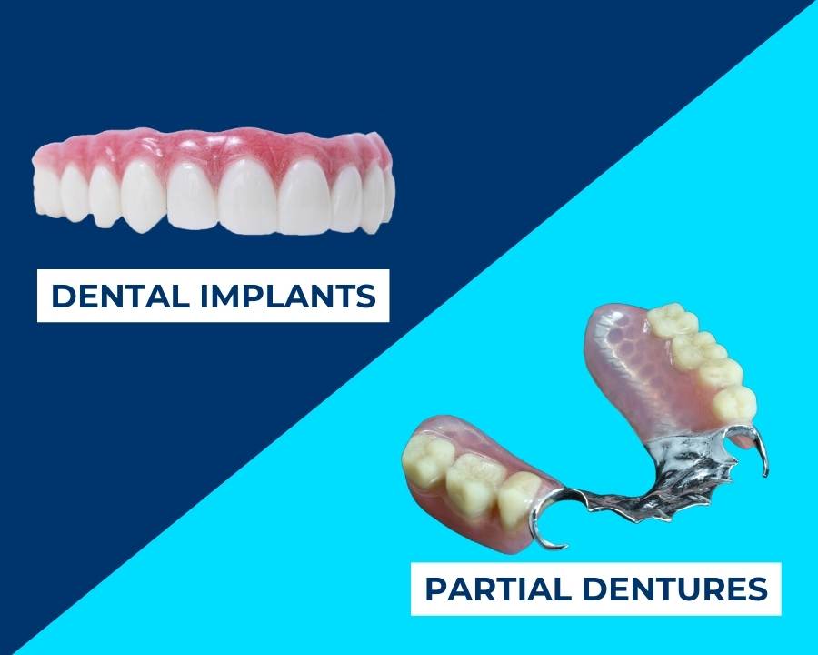Dental implants vs partial dentures