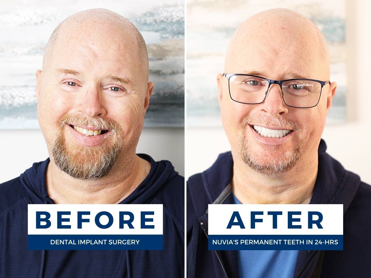 Dental implant patient before and after modern dental implant solutions