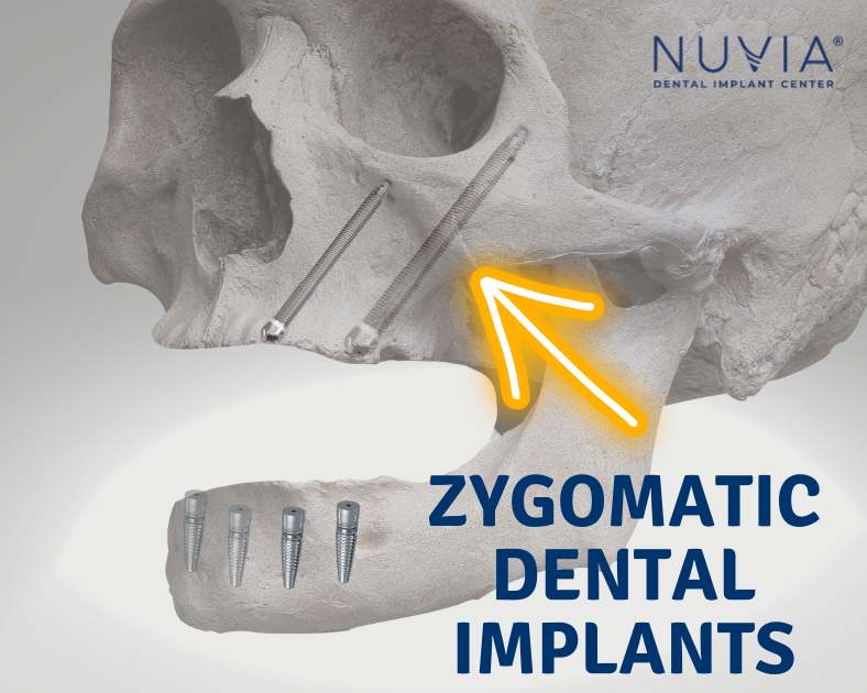 Zygomatic dental implants shown as a method to replace missing teeth