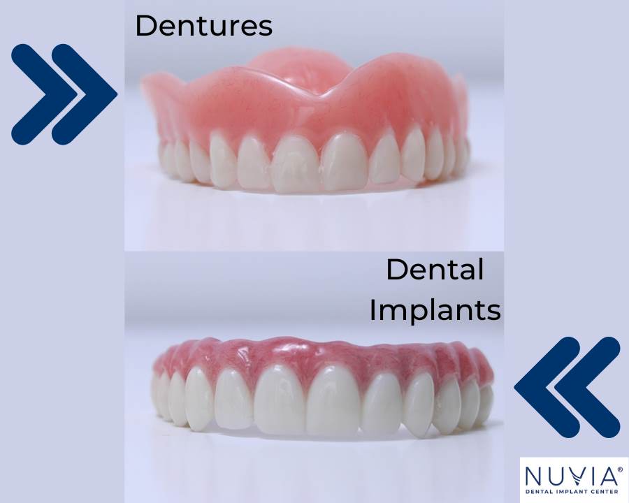 Dentures vs dental implant prosthetic to illustrate cost of dental implants in miami