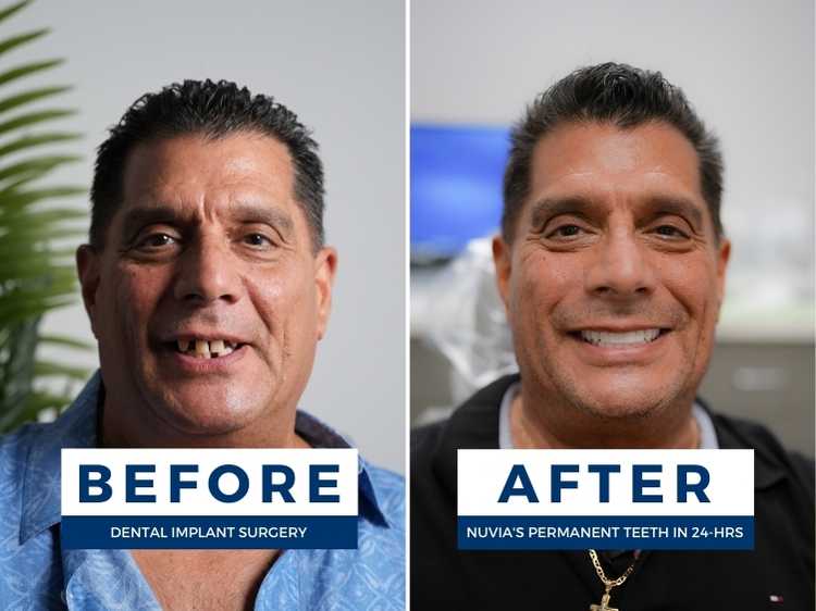 Smiling man before and after receiving full mouth dental implants to show the cost of dental implants in miami