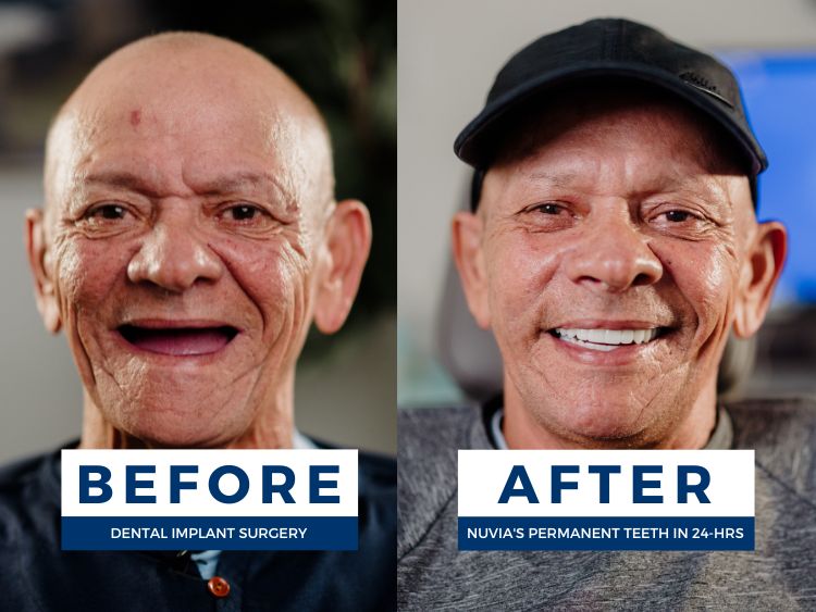 Dentures for elderly people didn't work for him so here is him smiling before and after dental implants