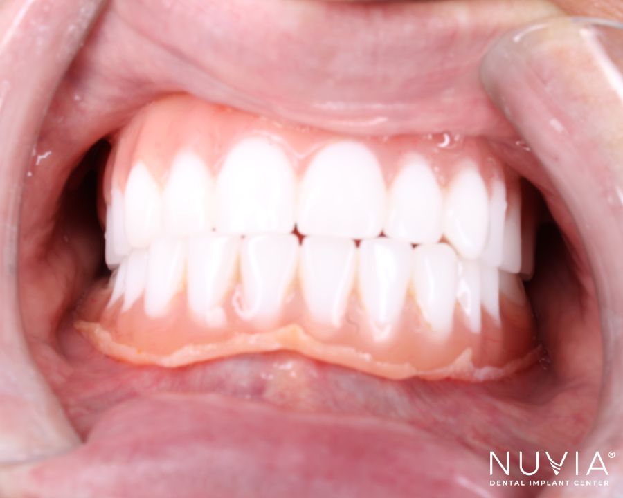 Terrible, uncomfortable dentures