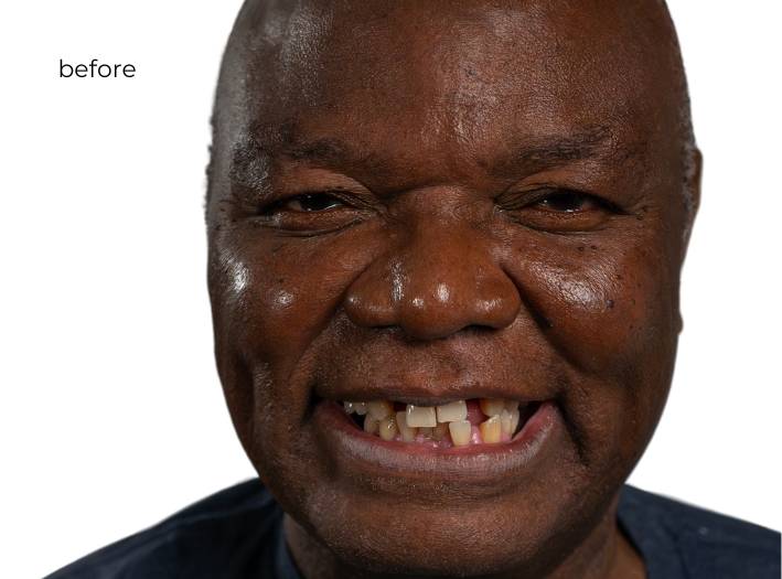 woman before getting dental implants