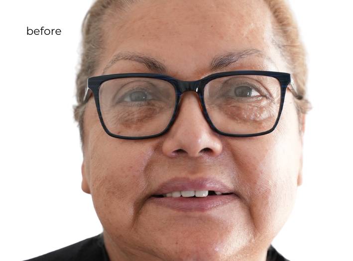 woman smiling before getting dental implants