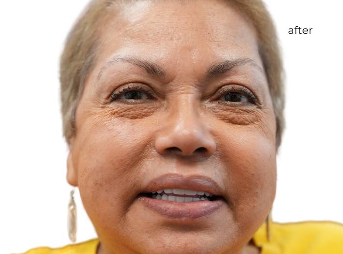 Woman smiling after getting dental implants