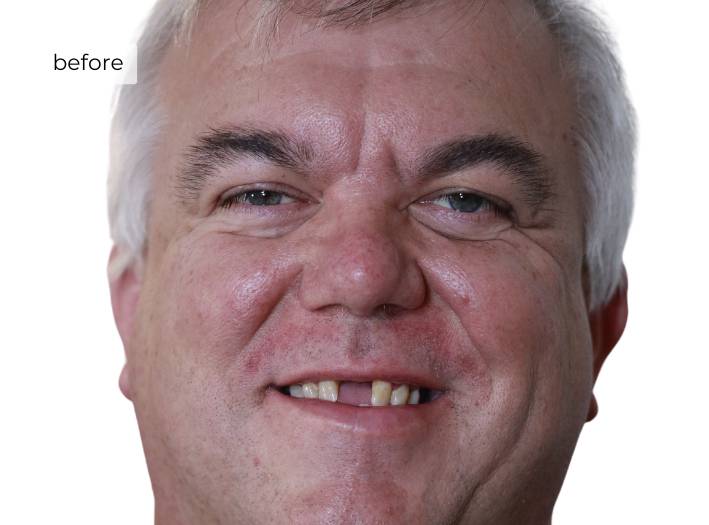 Man smiling before getting dental implants
