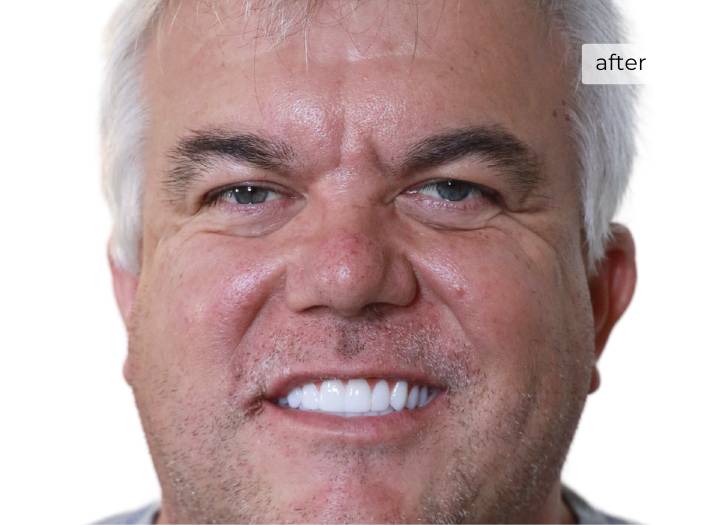Man smiling after getting dental implants