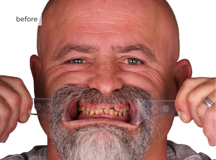 Man smiling before dental implants