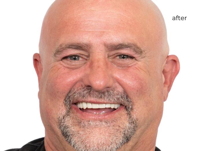 man smiling after getting dental implants