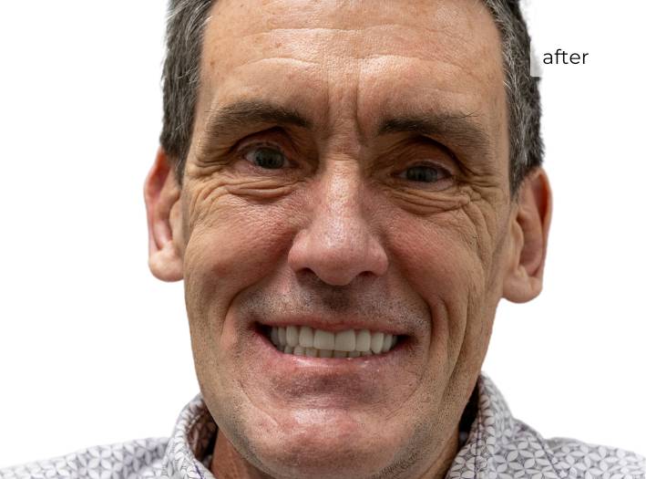 Man smiling after getting dental implants