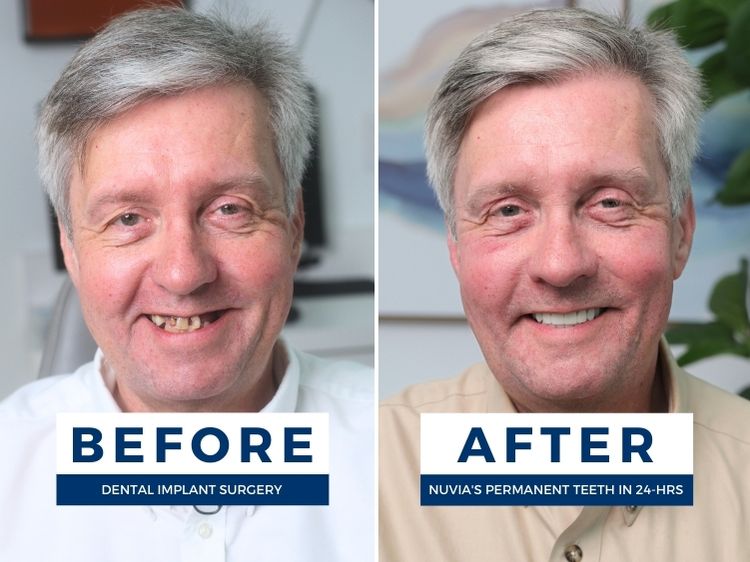 Before and after going to nuvia dental implant center in Moorestown to get new teeth