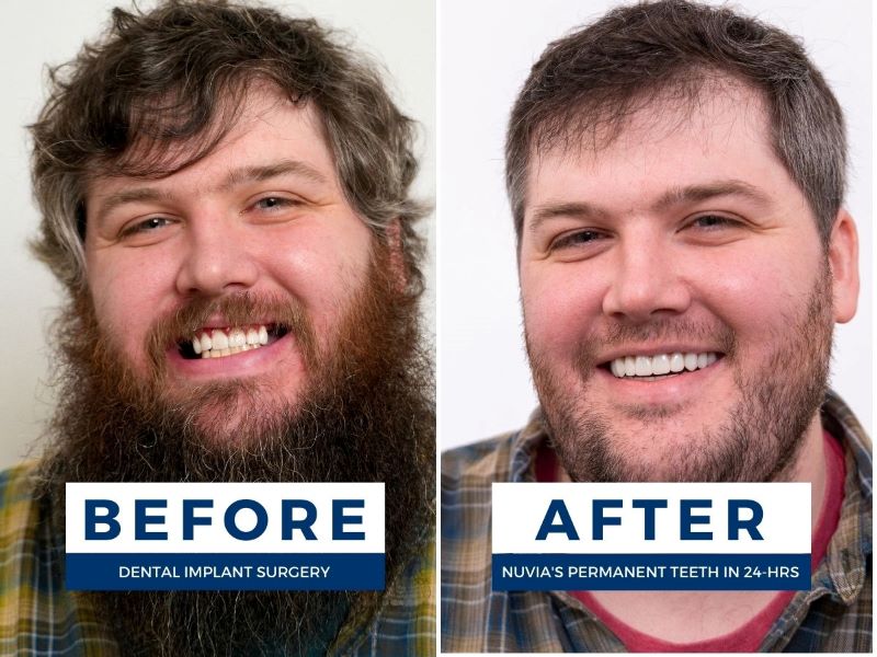 Man smiling before and after getting dental implants