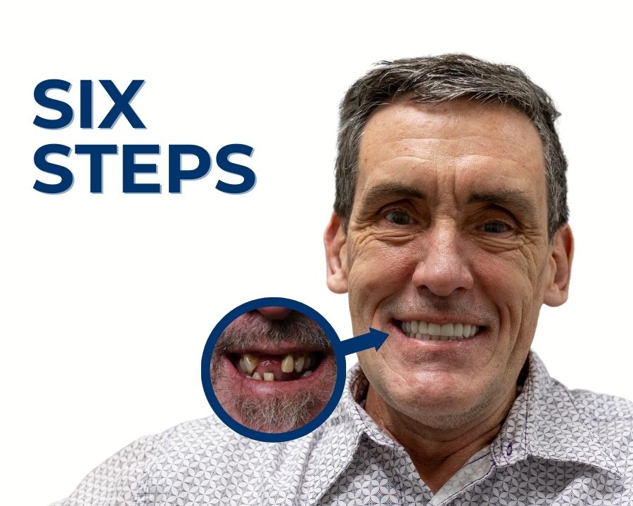 Man smiling after getting dental implants