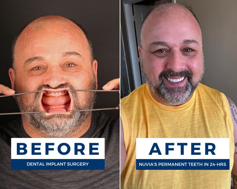 Randee smiling before and after full mouth restoration