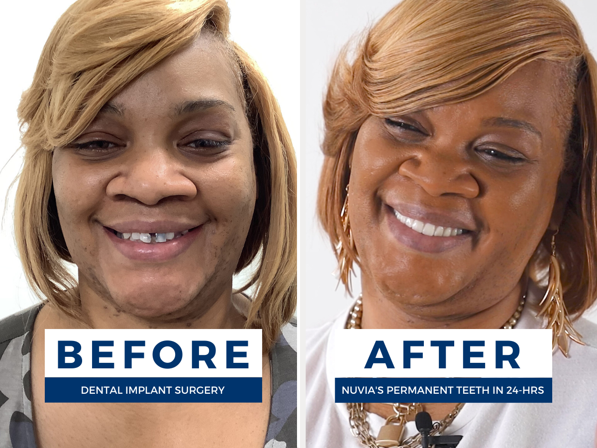 Sharanna smiling before and after full mouth restoration