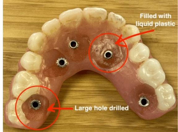 Permanent teeth implants don't look like these temporary teeth